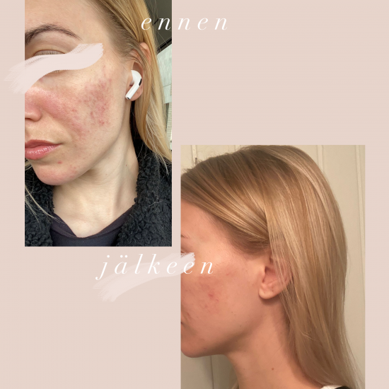 Antibacterial Face Oil Skin Care